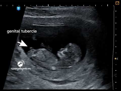Fetal gender at 11 Weeks