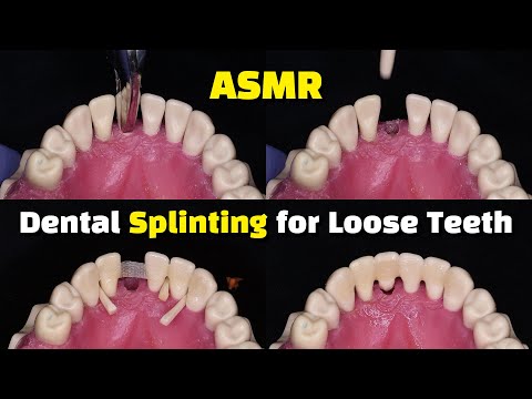 Dental Splinting for Loose Teeth using Ribbond after a Tooth Extraction
